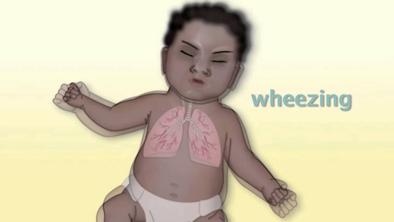 Common Pediatric Respiratory Problems by M. Kleinman | OPENPediatrics