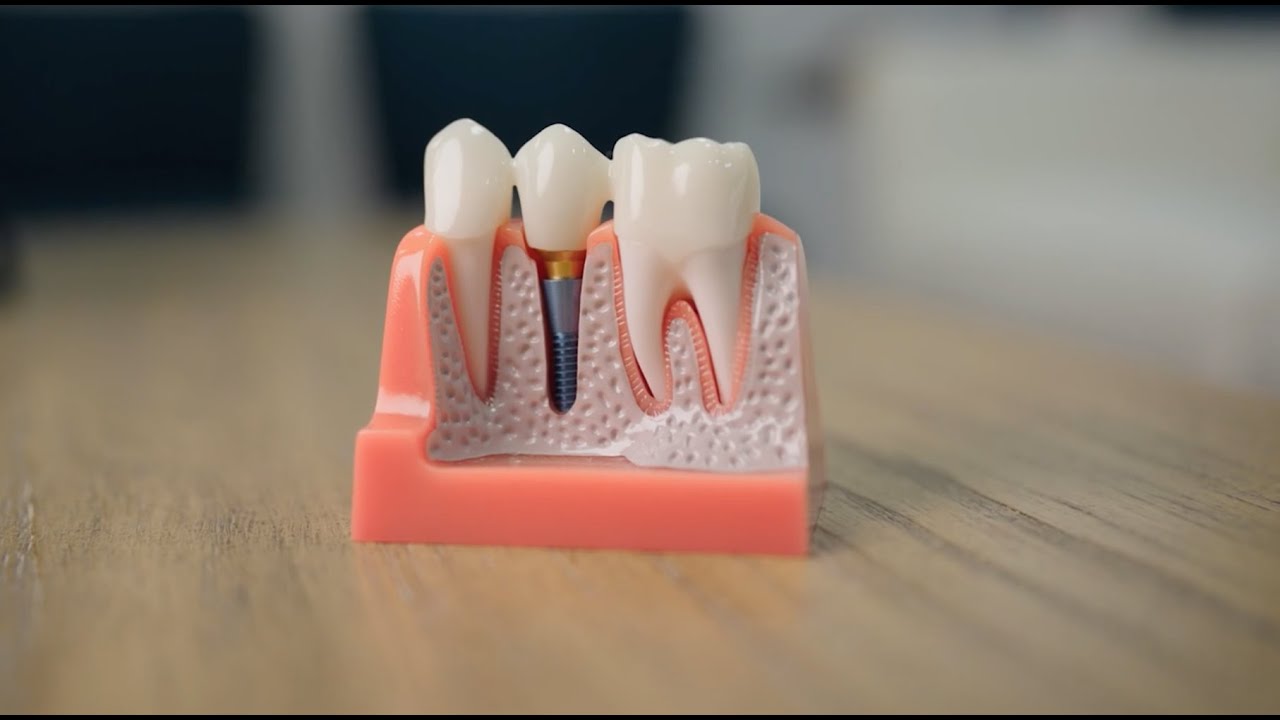 Why Choose Coastline Dental Implants As Your Provider?