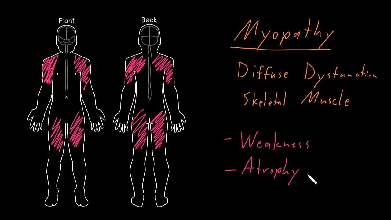 Syndrome: Myopathy