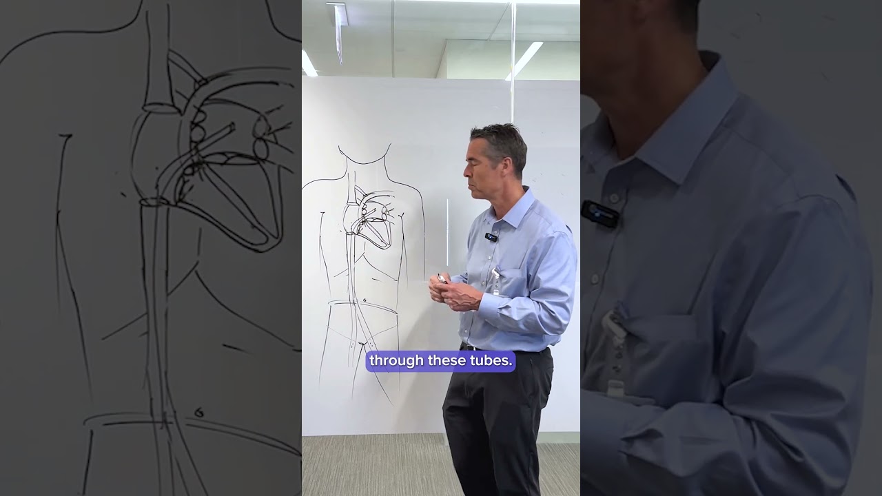 Afib: Catheter Ablation