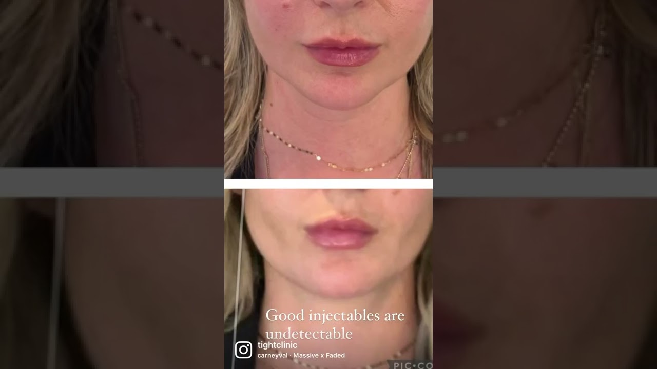Demonstrating 1 Syringe of Chin and Pre-Jowl Filler