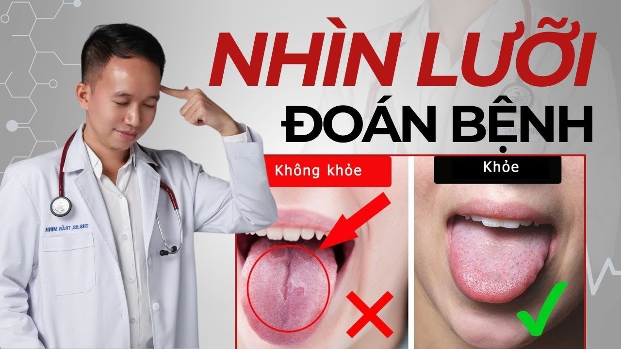 Nhìn Lưỡi Biết Bệnh - 6 dấu hiệu cảnh báo bệnh sớm mà bạn phải biết | Bác Sĩ Trần Minh