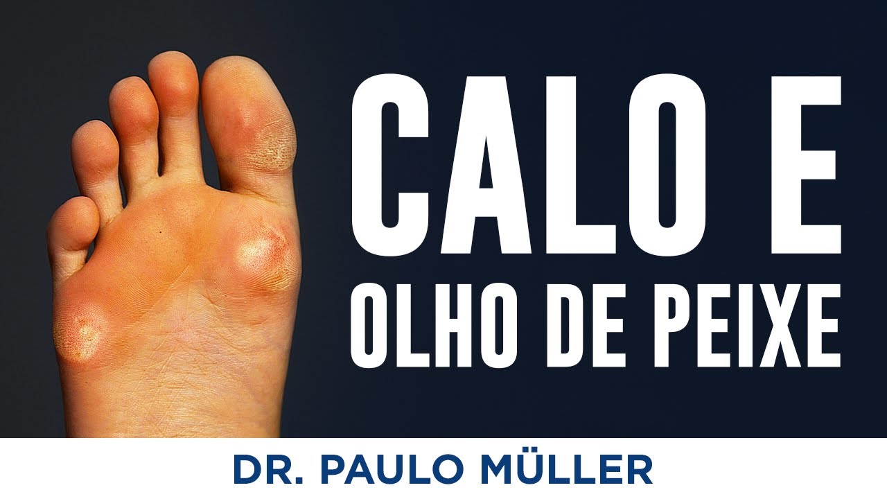 Calo e Olho de Peixe - Dr. Paulo Müller Dermatologista.