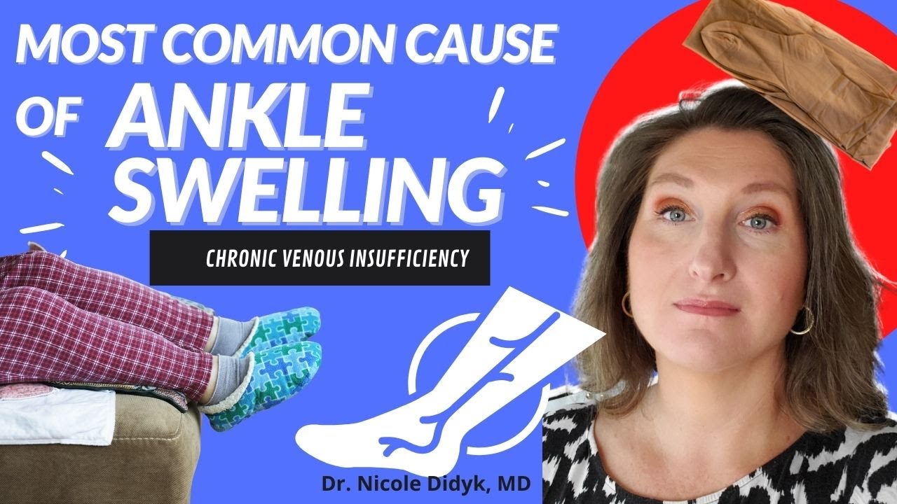 Commonest Cause of Swollen Ankles?  Chronic Venous Insufficiency (CVI)