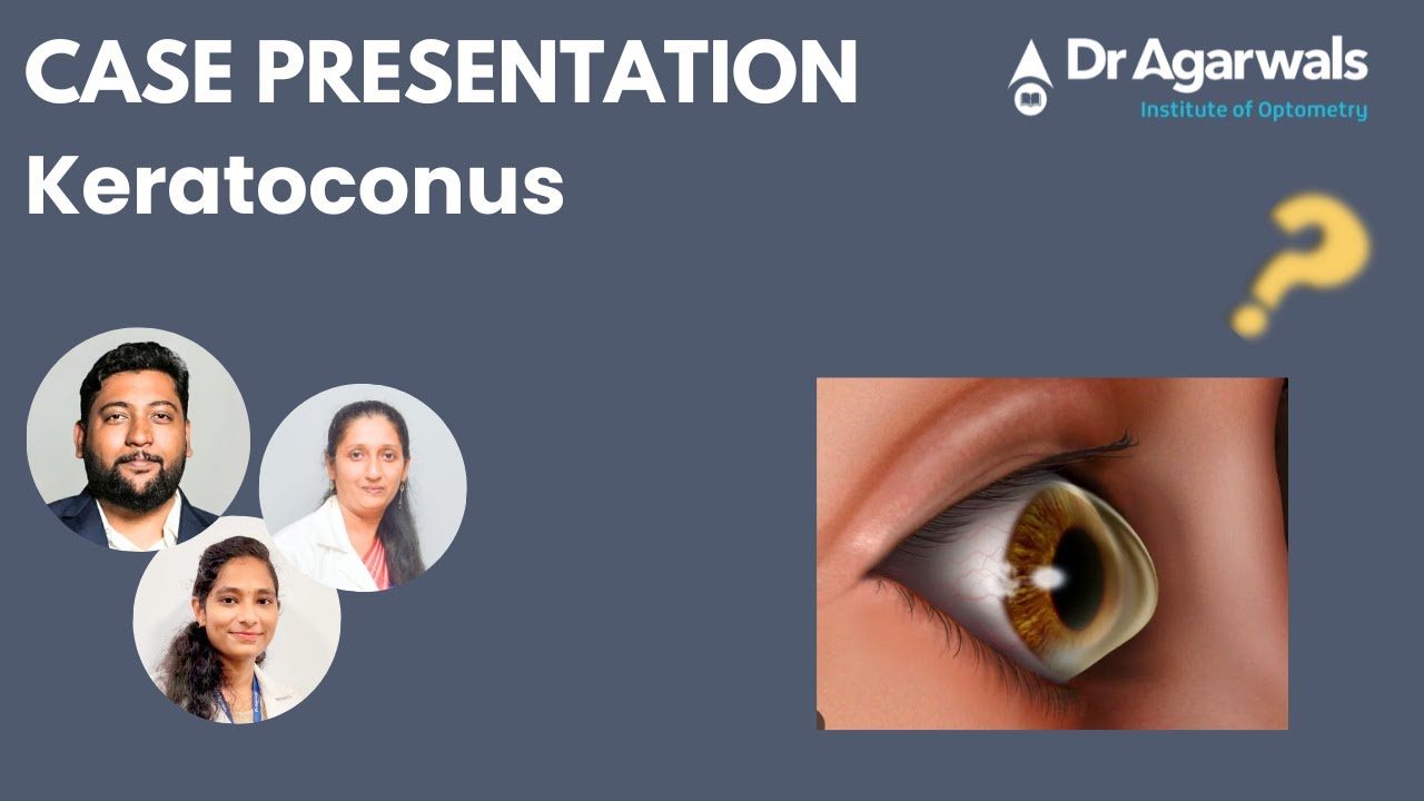 Case Presentation: Keratoconus
