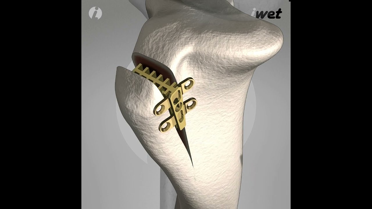 Technika operacyjna TTA R+ / TTA R+ Surgical Technique