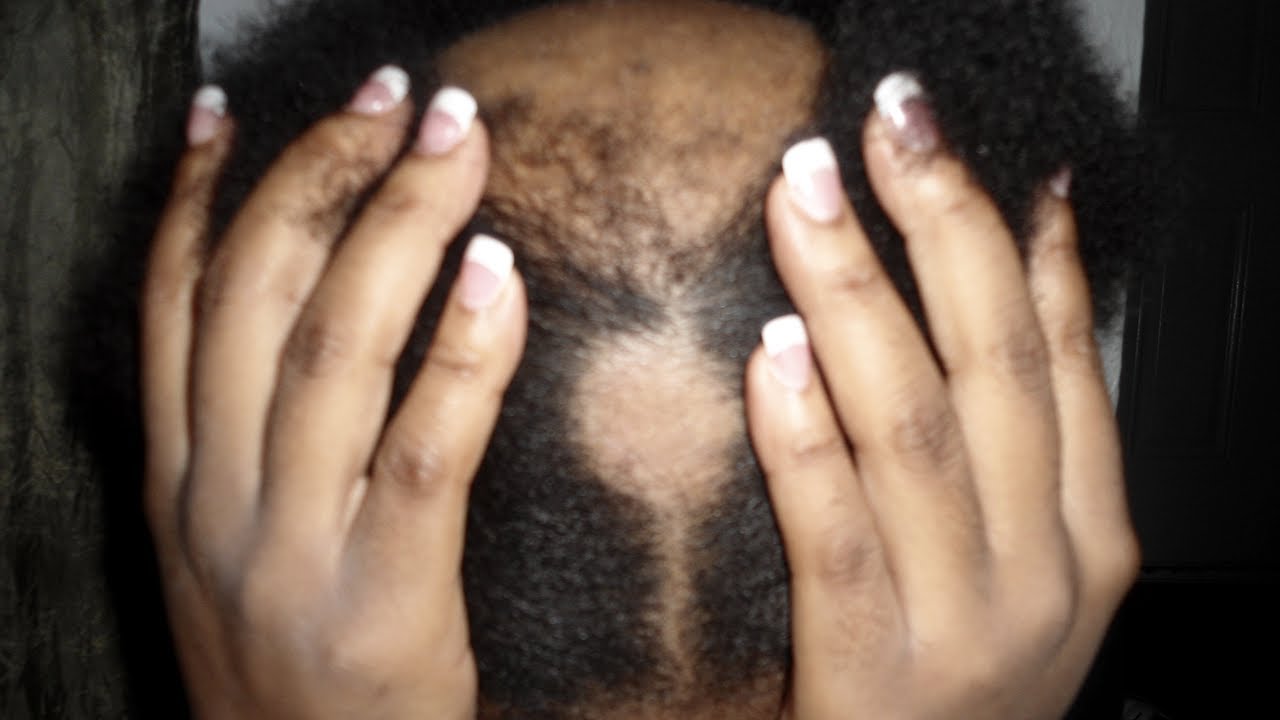 My Journey | Curing Alopecia Areata N A T U R A L L Y ! *(pics included)*