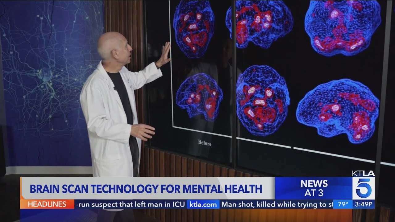 Brain scan helps address mental health issues L.A. firefighters, first responders face