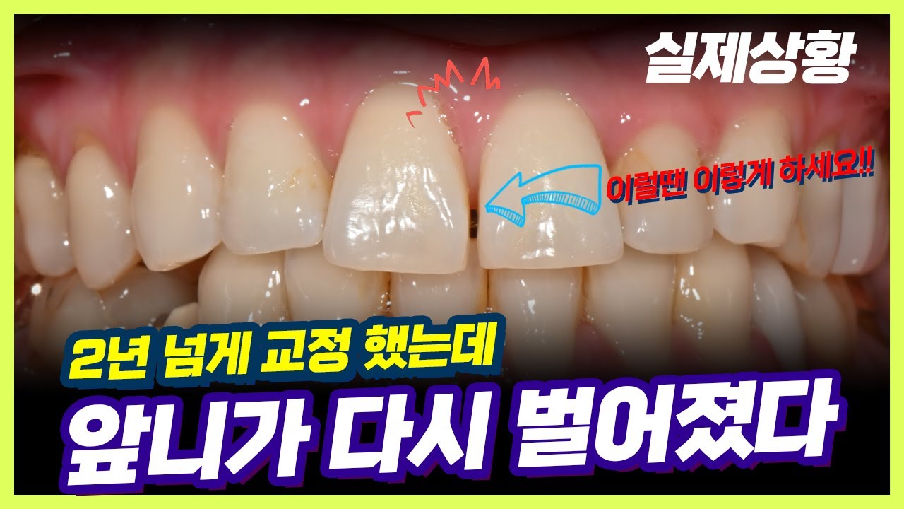 교정 한 번 했는데.. 다시 하는 황당한 상황 [#치아재교정 #발치교정 #턱관절장애 #dentist #orthodontist #orthodontics ]