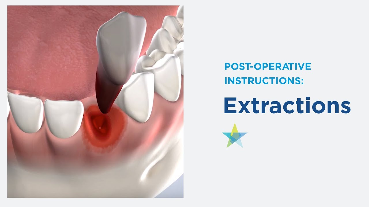 Post-Operative Instructions: Extractions | Park Cities Oral & Maxillofacial Surgery Associates