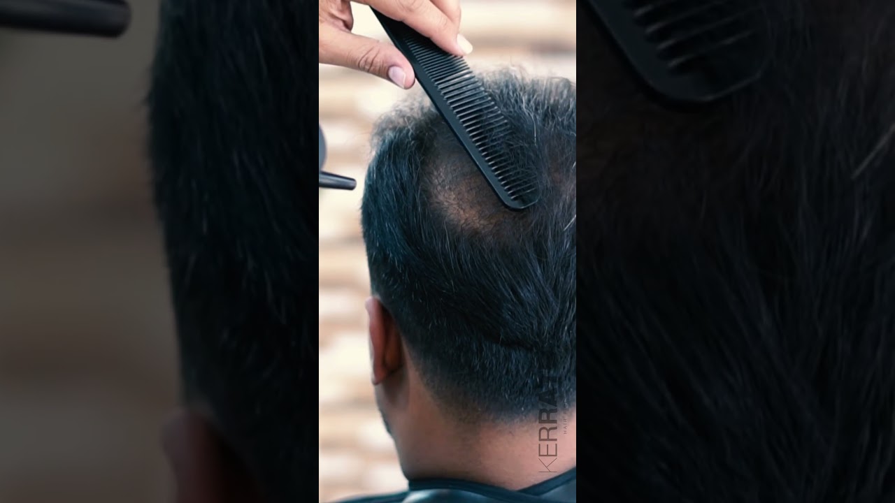 Shh... His Secret to Hiding a Frontal Bald Spot Revealed! 🤫🌿 #hairloss