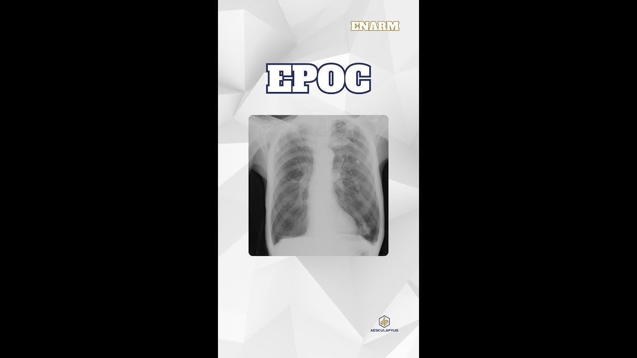 EPOC