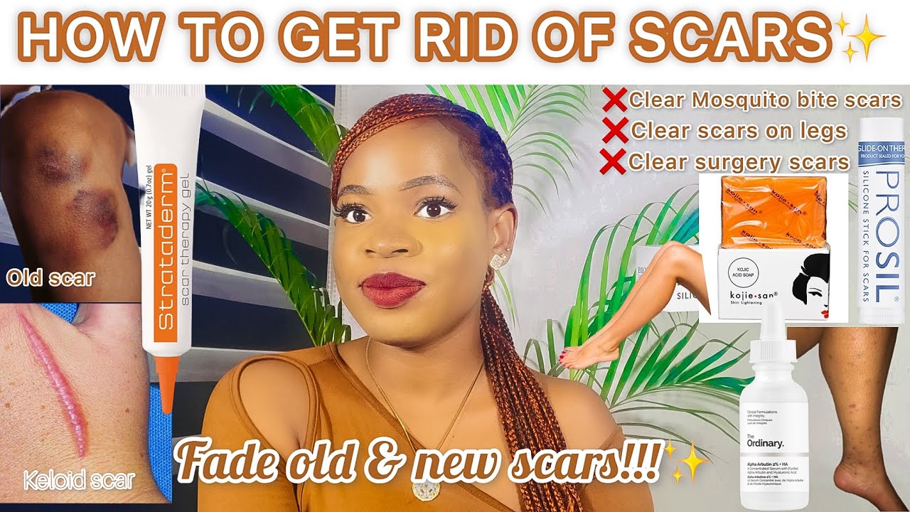 *HOW TO GET RID OF SCARS* *Mosquito Bites*|*Scars On Legs*|*Surgery Scars*|*Old Scars* +*Fade Scars*
