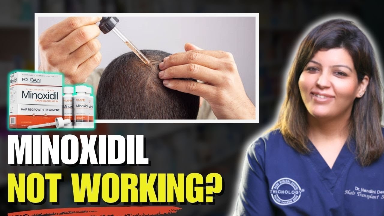 Minoxidil Not Working? Minoxidil Non-Responder Explained | Dr. Nandini Dadu | DMC Trichology