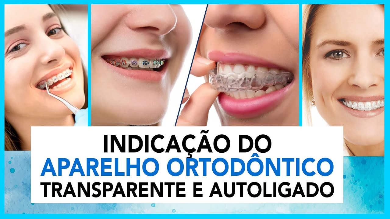 Indicação do Aparelho Ortodôntico Transparente e Autoligado