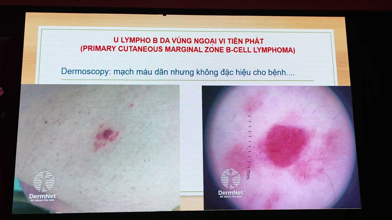 BỆNH U LYMPHO B Ở DA - TS THÁI HÀ - BV DLTW