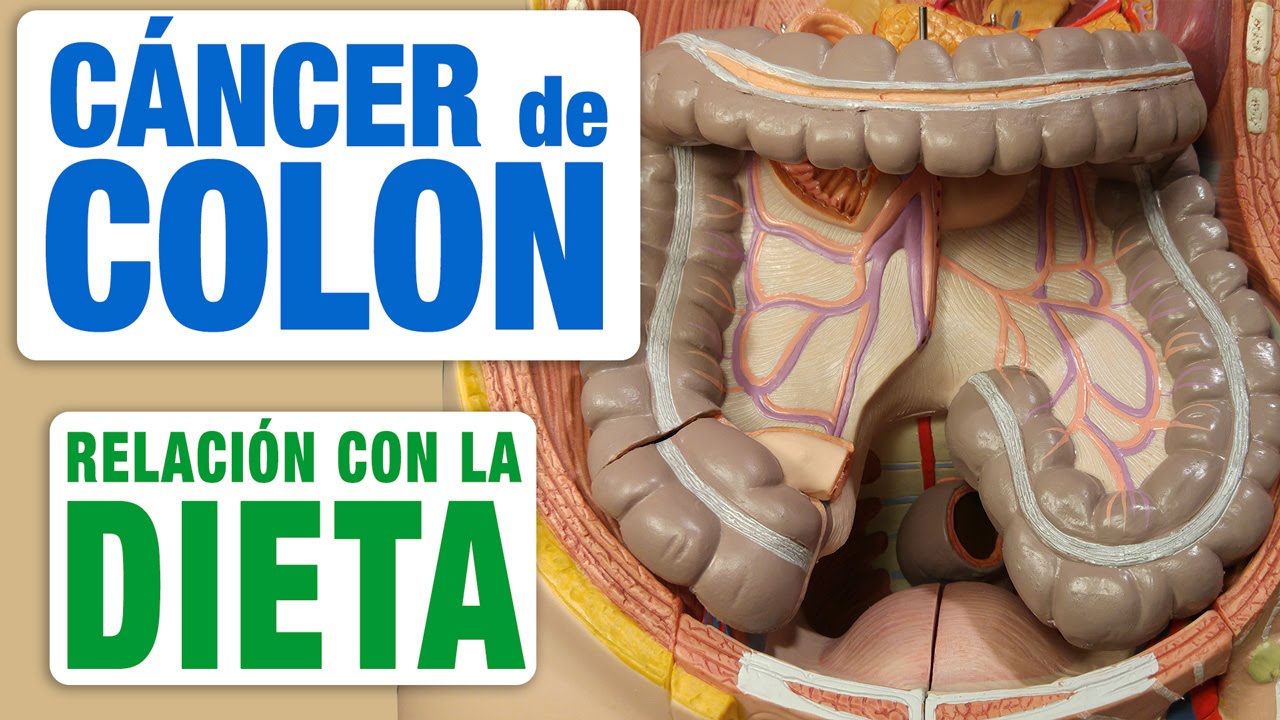 Cáncer de Colon y Dieta