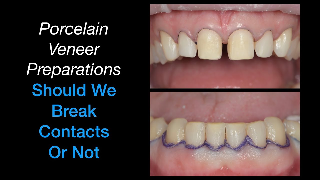 Porcelain Veneer Preparations. Should we break contacts or not?