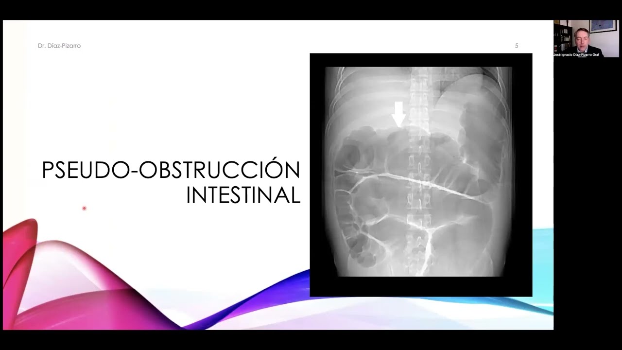 Sesión Académica; Pseudoobstrucción y Oclusión Intestinal: ¿Cuándo alimentar y qué hacer?