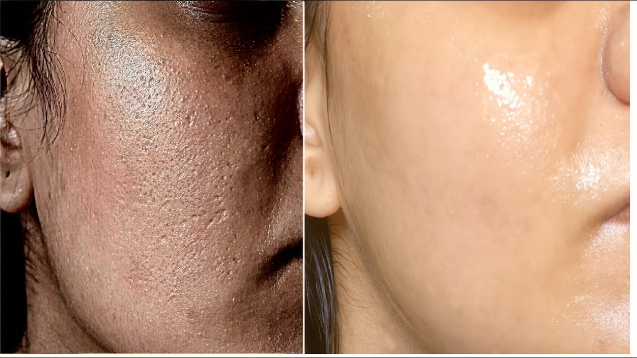 How to get rid of Large OPEN PORES permanently