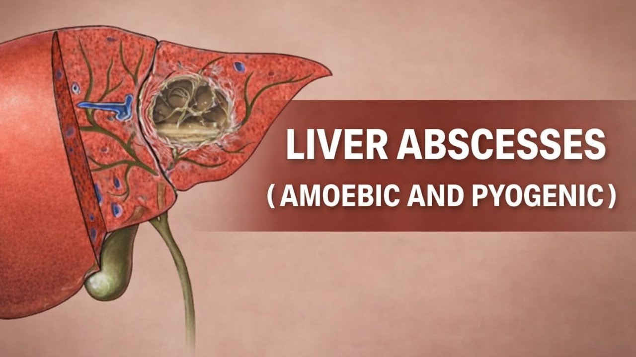 LIVER ABSCESSES | AMOEBIC AND PYOGENIC  | CLINICAL FEATURES DIFFERENTIATION INVESTIGATION MANAGEMENT