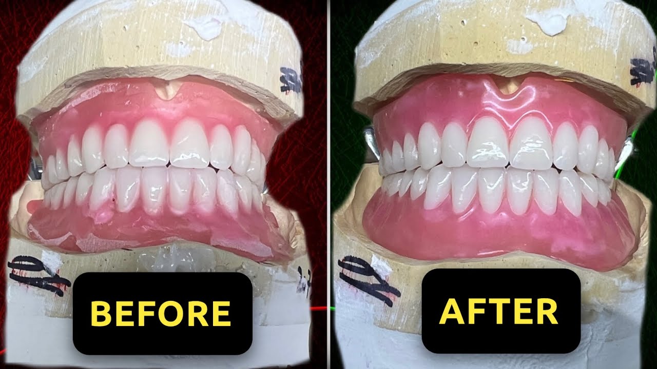 4 Minutes Full Denture Setup | Dental Lab Speed Technique