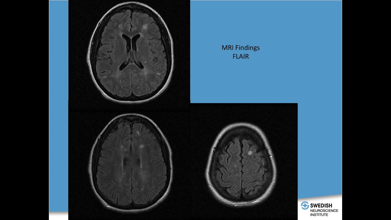 MS 101 - James Bowen, MD - October 2018