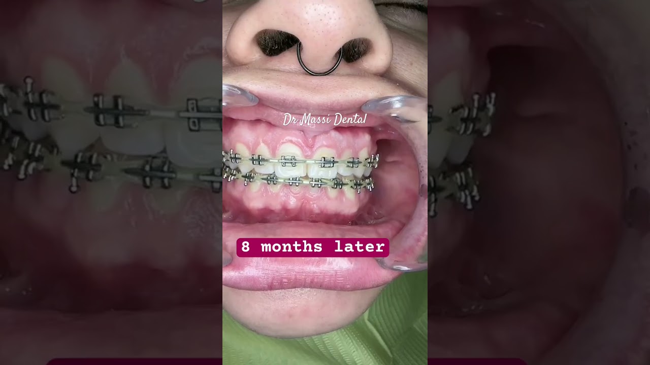 DENTAL BRACES in 18 Months progress!