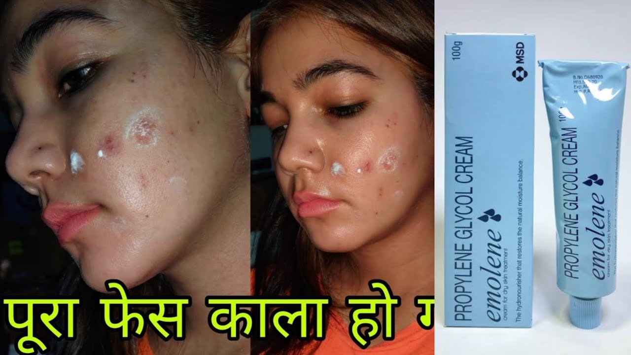STOP 🛑 USING EMOLENE CREAM |  Skin Whitening Cream || EMOLENE Cream in Hindi | पूरा फेस काला हो गया