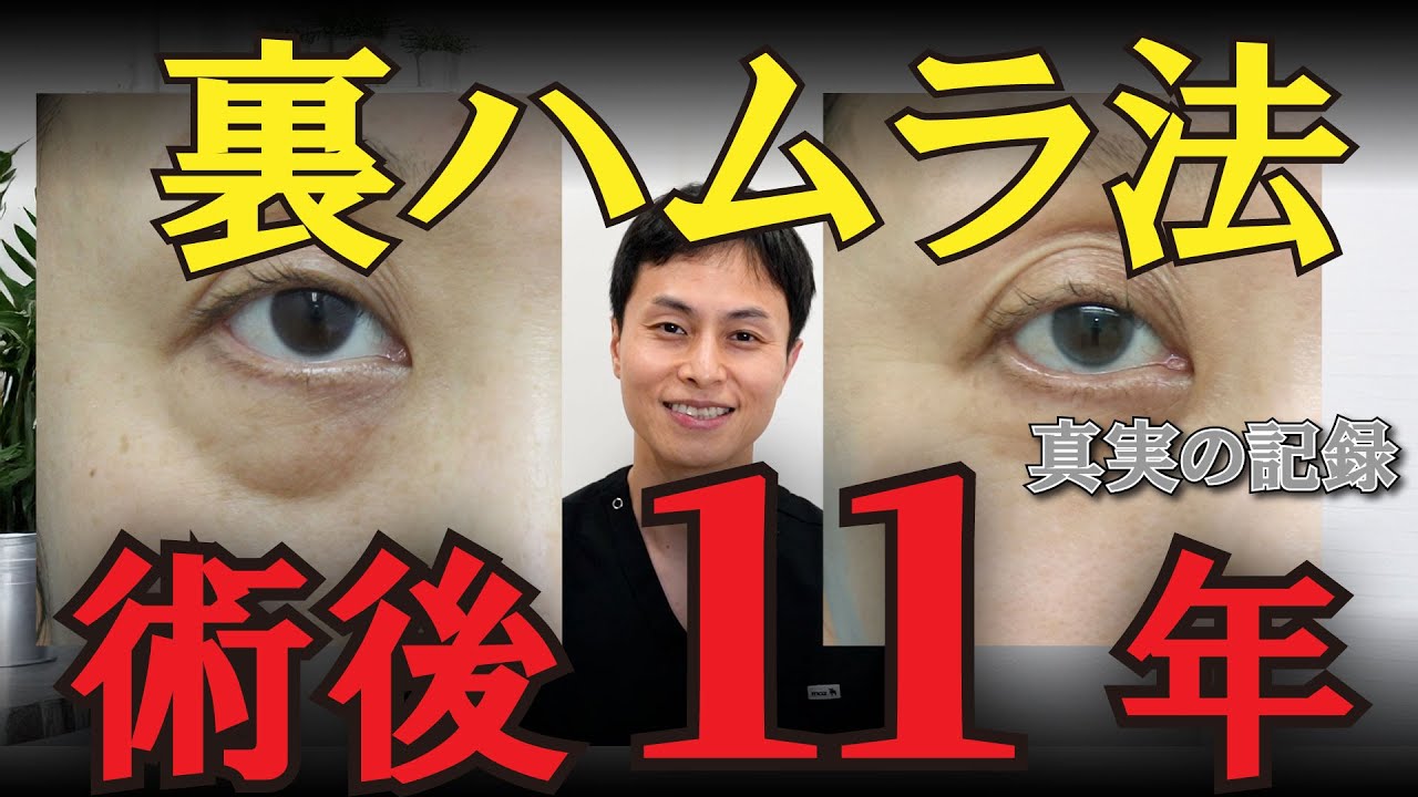 【目の下のクマ・たるみ治療】裏ハムラ法術後11年の記録。裏ハムラ法の長期経過について形成外科専門医がお伝えします