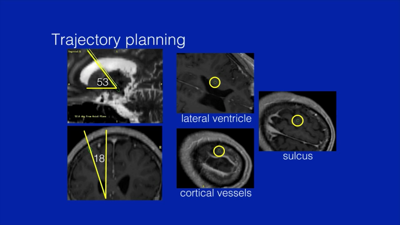 Coaxial Interleaved Stimulation of the Thalamus and Subthalamus for Treatment of Holmes Tremor