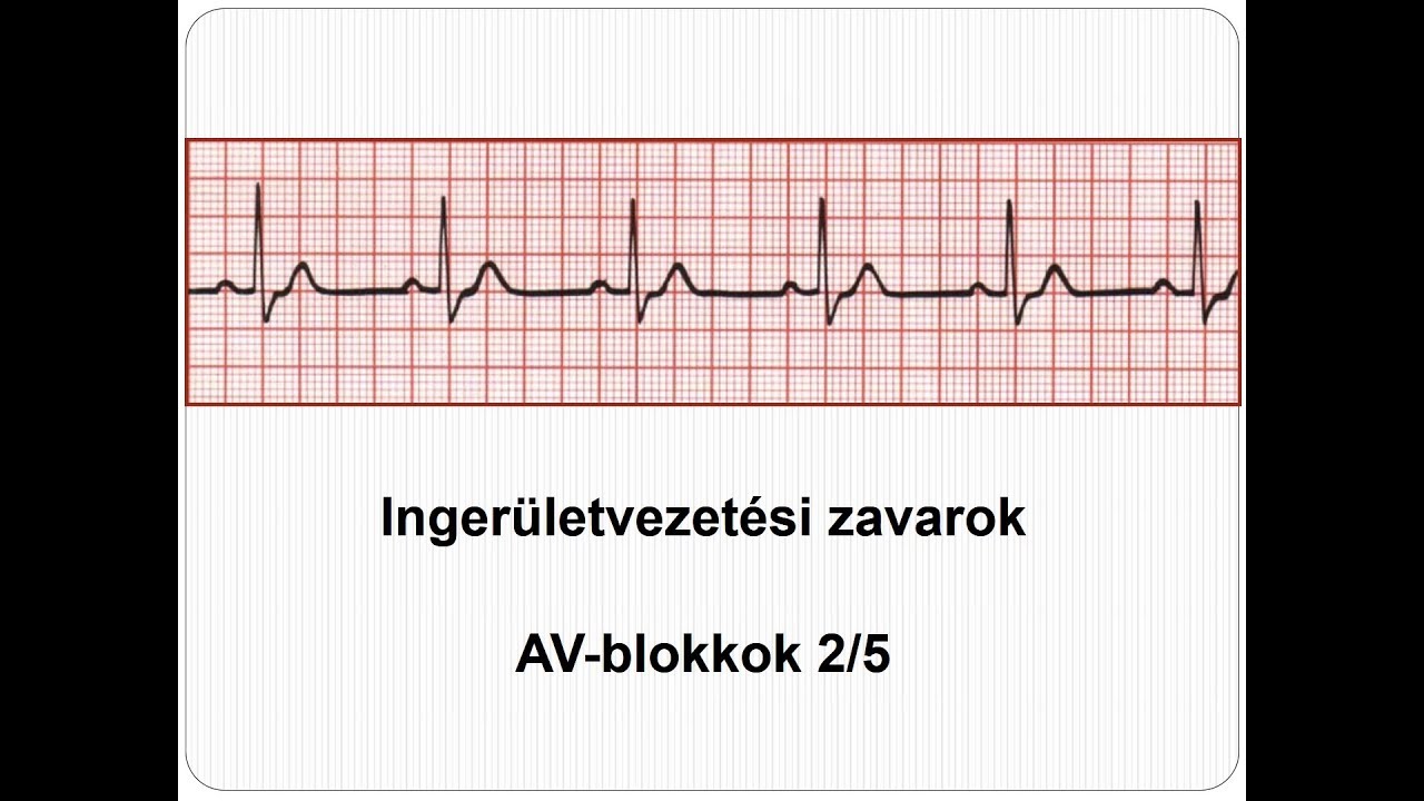 EKG Ingerületvezetés zavarai_ AV-blokkok 2018. 2_5