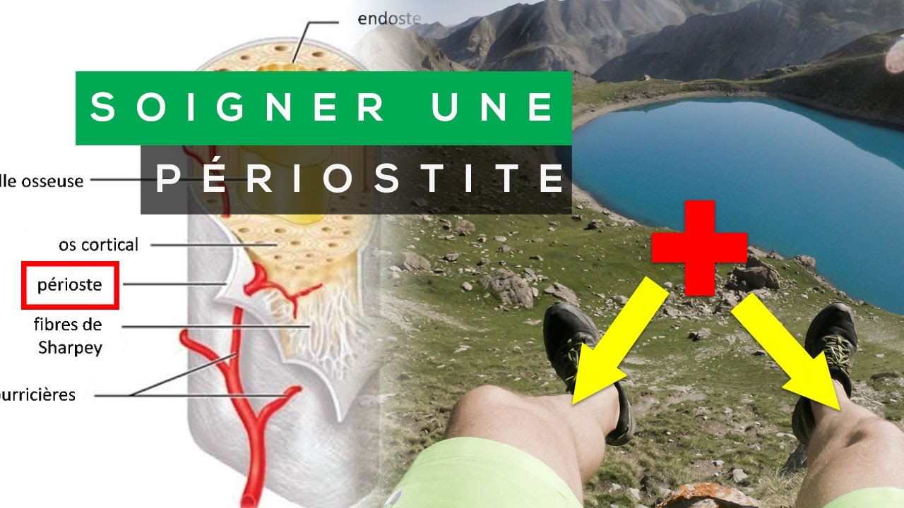 COMMENT SOIGNER UNE PÉRIOSTITE ?