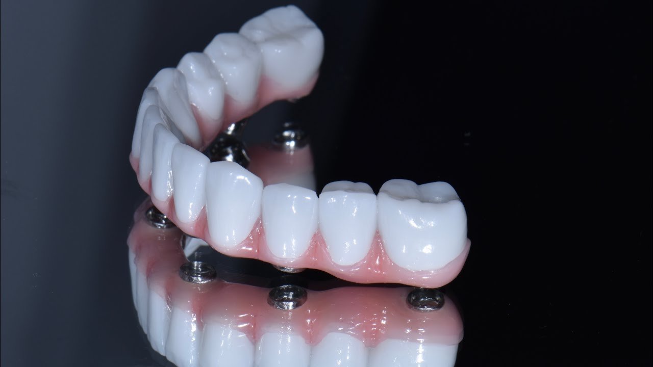 Lucrare fixa din zirconiu pe implanturi - full arch implant