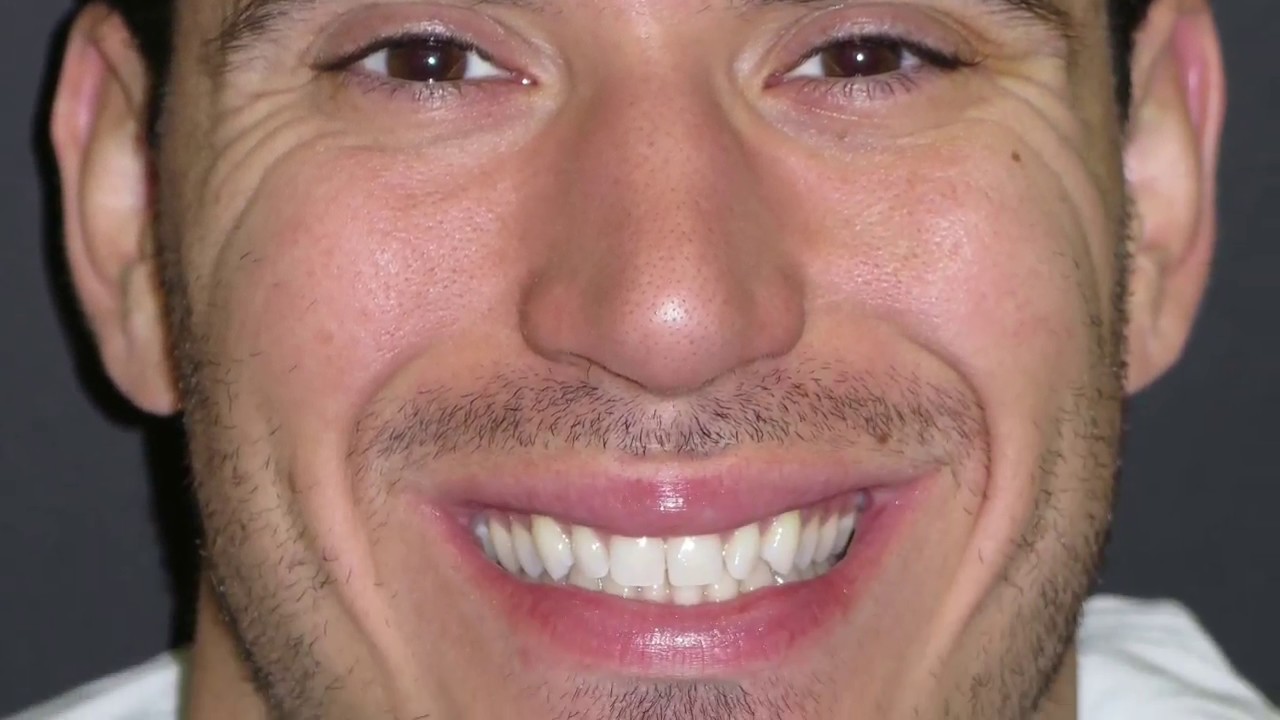 Bioclear Veneers: 5 teeth in 5 mins