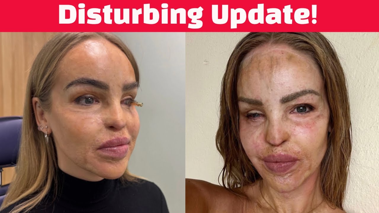 Loose Women star Katie Piper Reveals Heartbreaking Update Years After Devastating Acid Attack