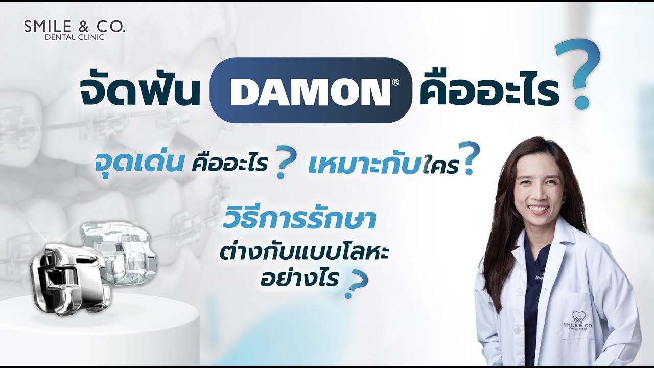 จัดฟันดามอน (Damon) คืออะไร? จุดเด่น ? เหมาะกับใคร ? วิธีการรักษา