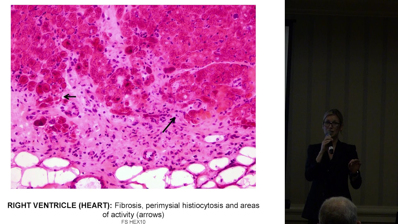 Myositis and Heart Disease, Dr. Christina Charles-Schoeman 2017 Annual Patient Conference