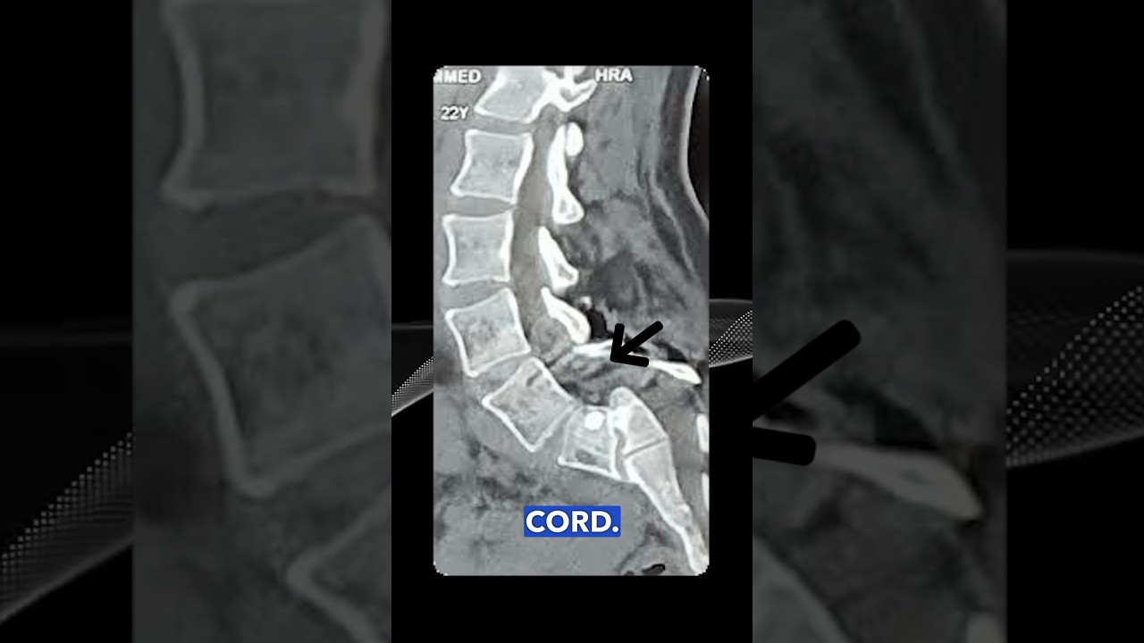 broken spine. #spine #spinehealth #backpain #backpainrelief #backexercise #neckpain #chiropractor