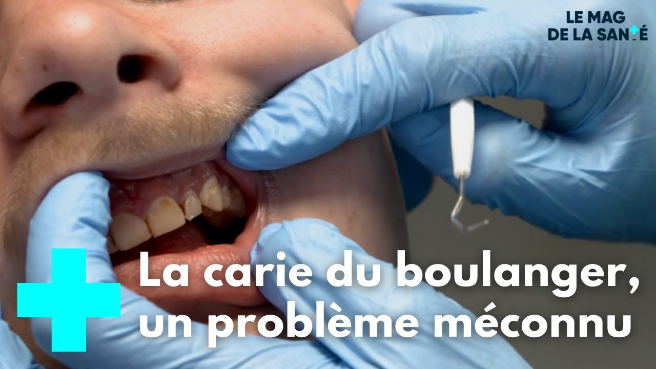 Prévenir la carie du boulanger - Le Magazine de la Santé