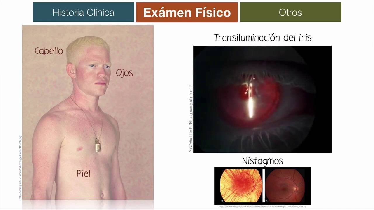 Albinismo: enfoque genético-clínico