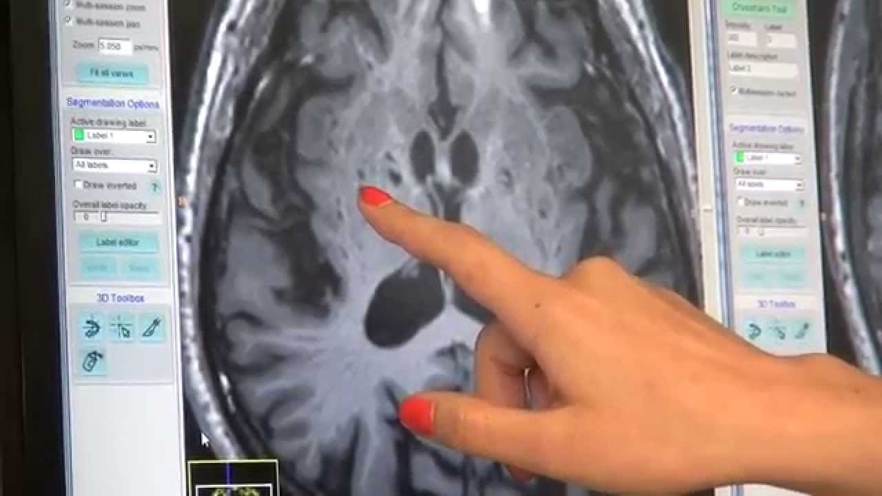 Poor sleep may affect brain's ability to clear waste
