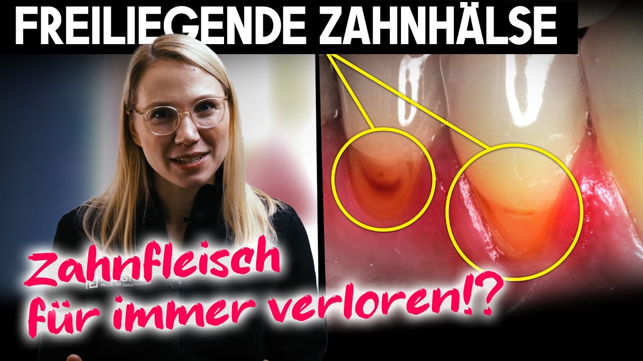 Freiliegende Zahnhälse. Ist einmal verlorenes Zahnfleisch für immer verschwunden? Was bedeutet das?