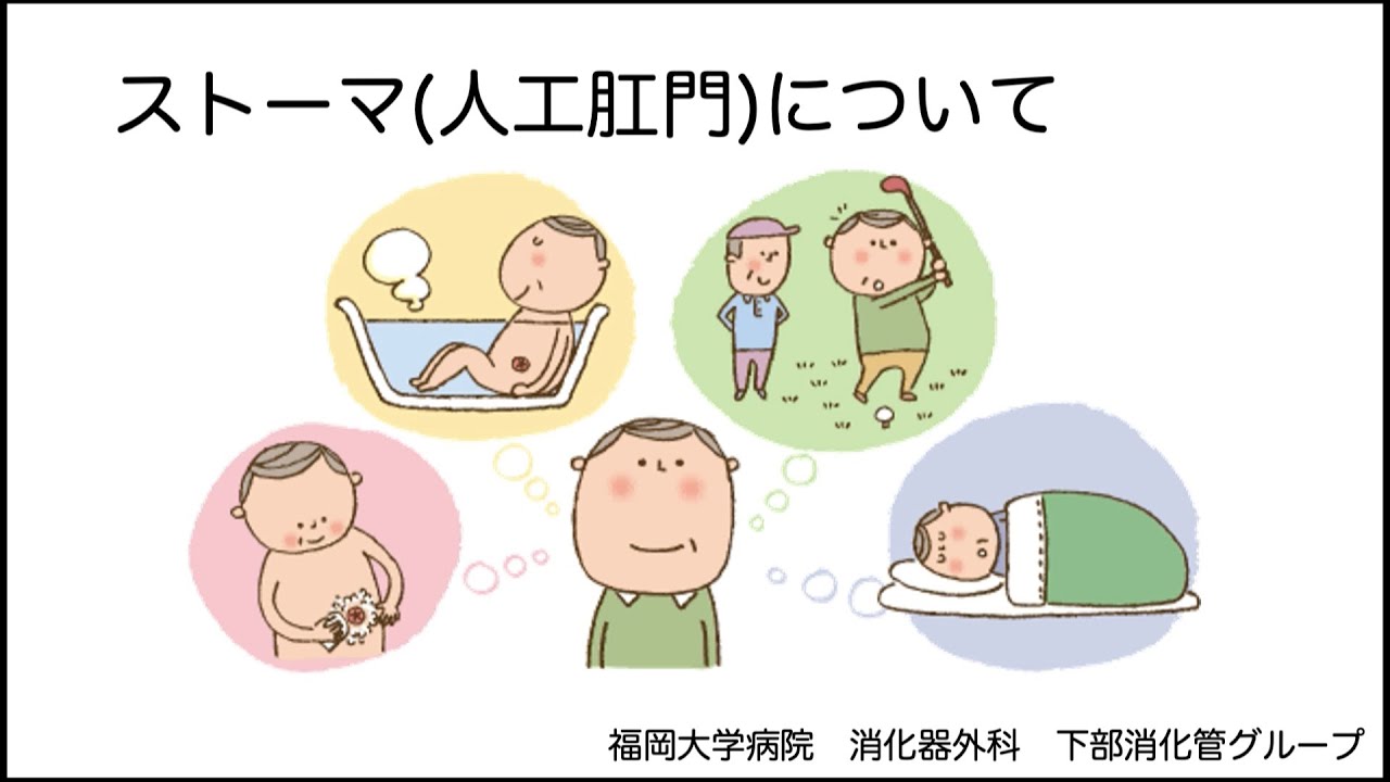 福岡大学消化器外科　人工肛門(ストーマ)について【福岡大学病院公式チャンネル】