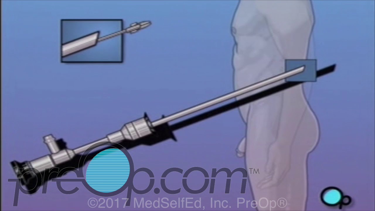 Male Cystoscopy Procedure | PreOp&reg;  Patient Education