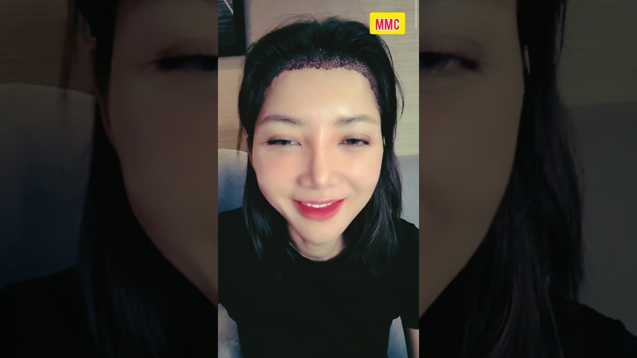 TEH NOVI KETAWA NGAKAK SENDIRI GEGARA HAIR TRANSPLANT DIBILANG MIRIP MICHAEL JACKSON JINNY OH JINNY