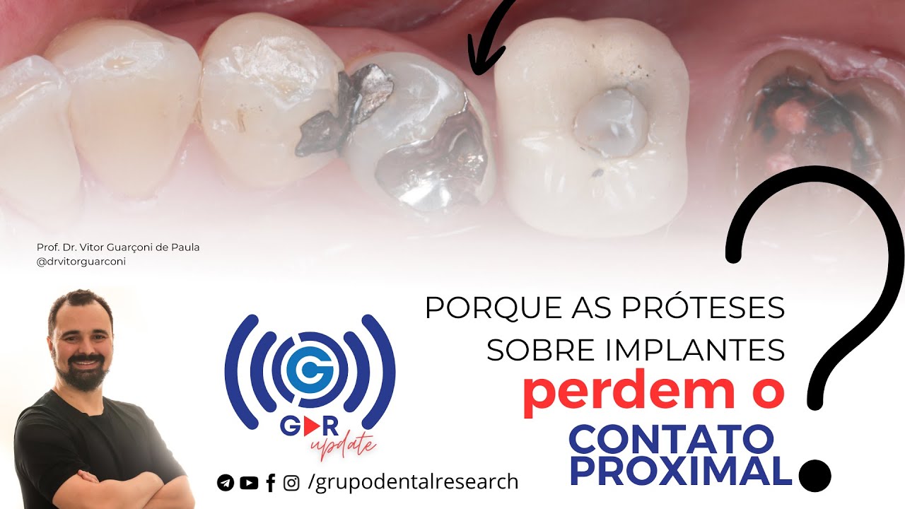 Perda do Contato Proximal em Prótese sobre implante: o que a ciência revela? - GDR UpDate