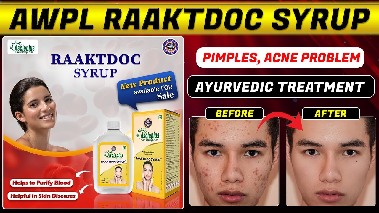 AWPL RAAKTDOC ( Pimples - Acne) कील – मुहांसे हटाने का जबरदस्त इलाज // Ayurvedic Treatment //