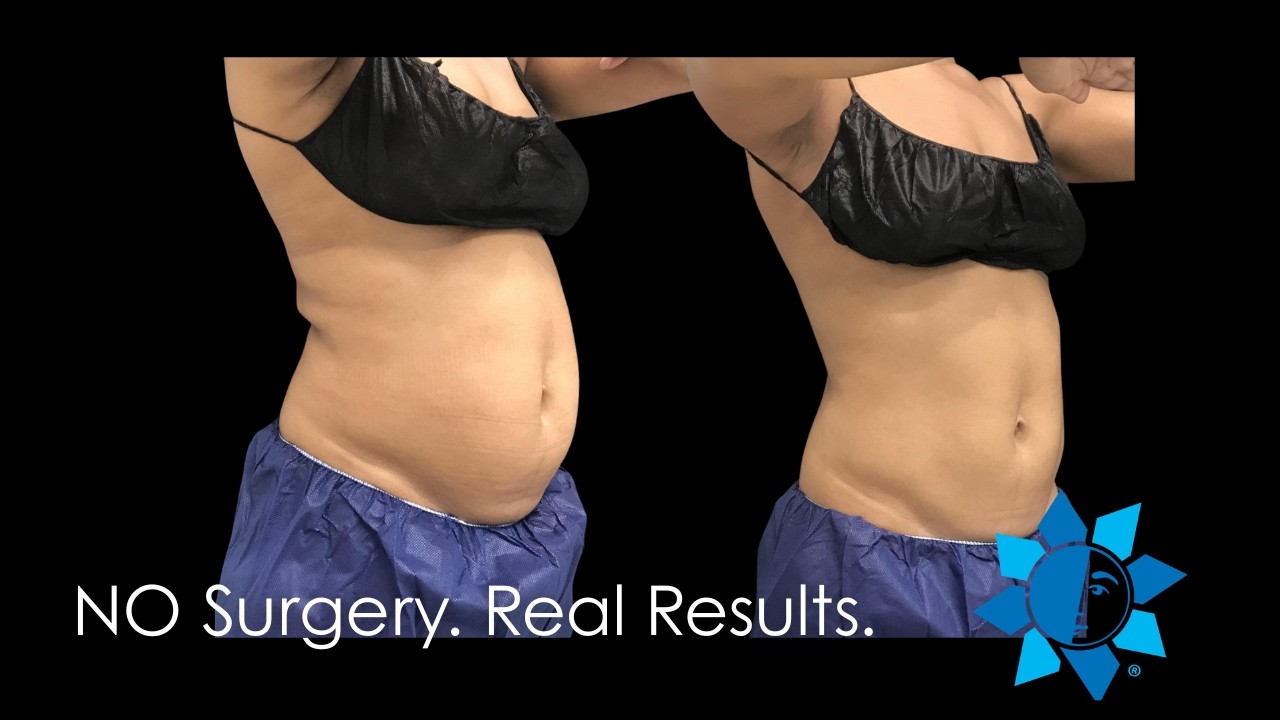 Stubborn Fat After Weight Loss? CoolSculpting in Athens GA
