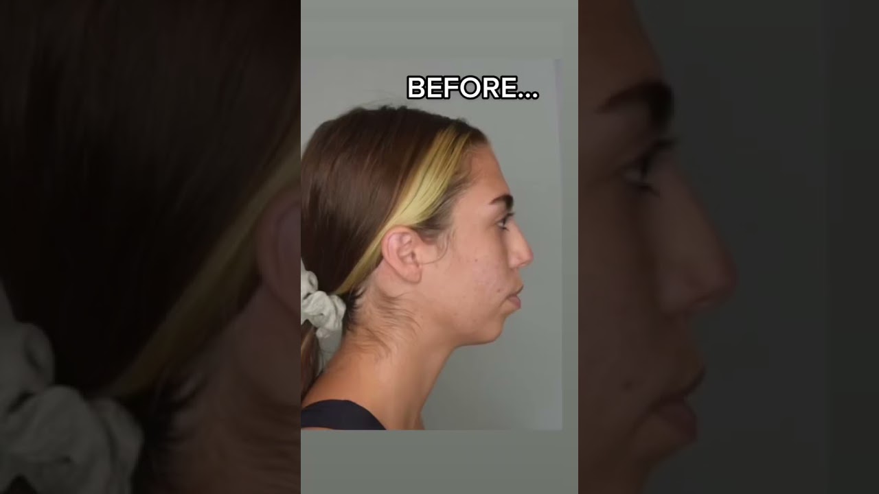 Chin Implant BEFORE & AFTER #plasticsurgery #beforeandafter #chinimplant